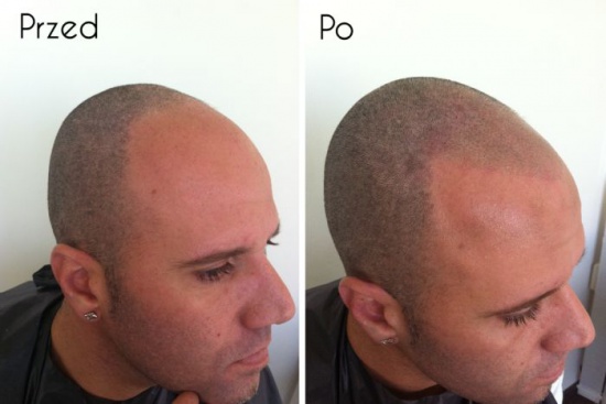 MIKROPIGMENTACJA WŁOSÓW-